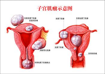 定期检查胜过子宫肌瘤治疗